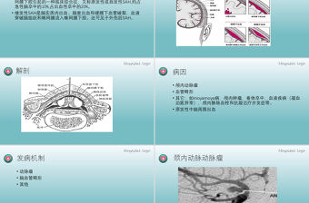 2022蛛網膜下腔出血PPT創意簡約醫療教學各種疾病醫理PPT模板