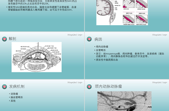 2022蛛网膜下腔出血PPT创意简约医疗教学各种疾病医理PPT模板